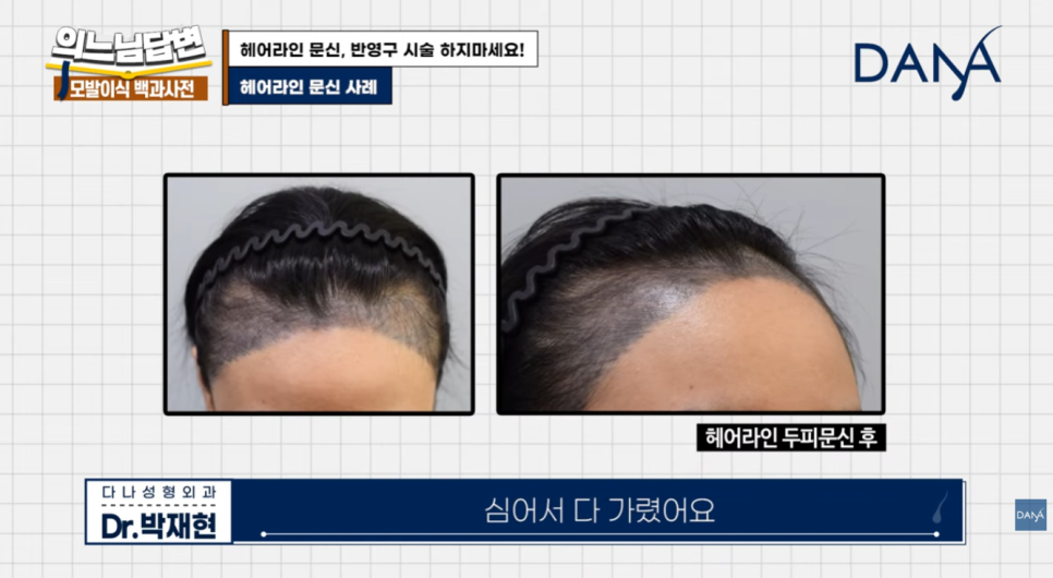 Why You Should Never Get a Hairline Scalp Tattoo image 11