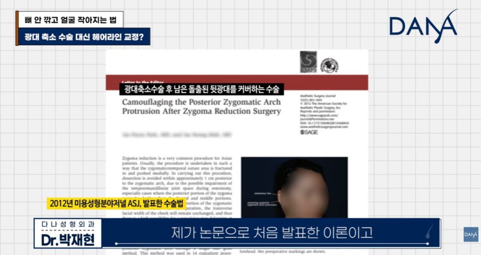 뼈 안 깎고 얼굴 작아지는 법? 광대 수술 효과 없는 관련 이미지 2