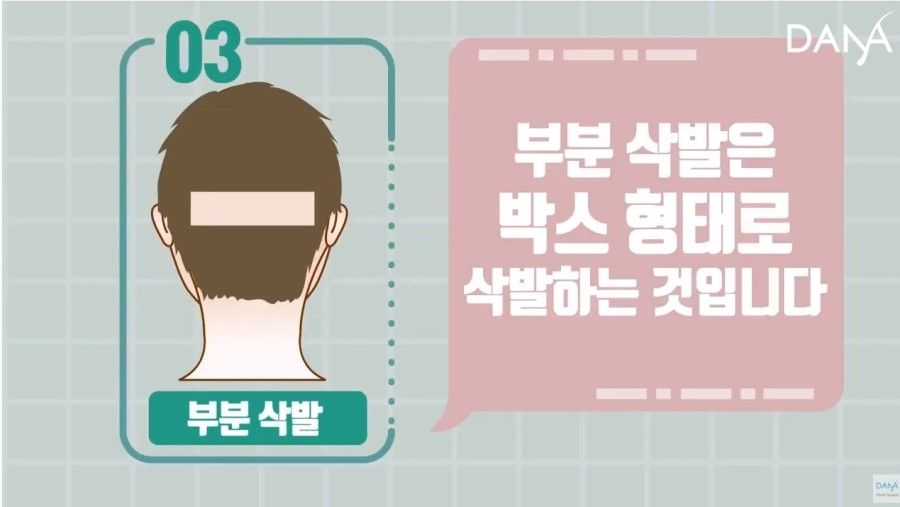 비절개 모발이식 시 삭발방법 종류 관련 이미지 7