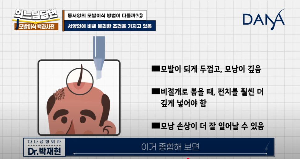 인종별 모발이식, 어떻게 다를까?② 관련 이미지 4