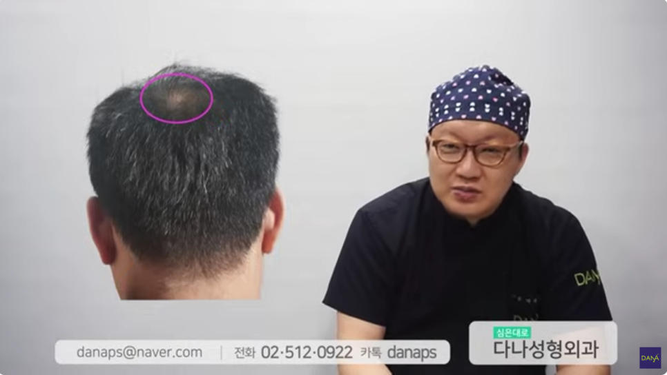 Cases Where You Should Not Get Hair Transplant Surgery, Explained by a Hair Transplant Clinic Doctor image 4