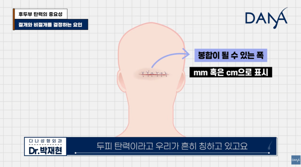 모발이식 전 관련 이미지 1