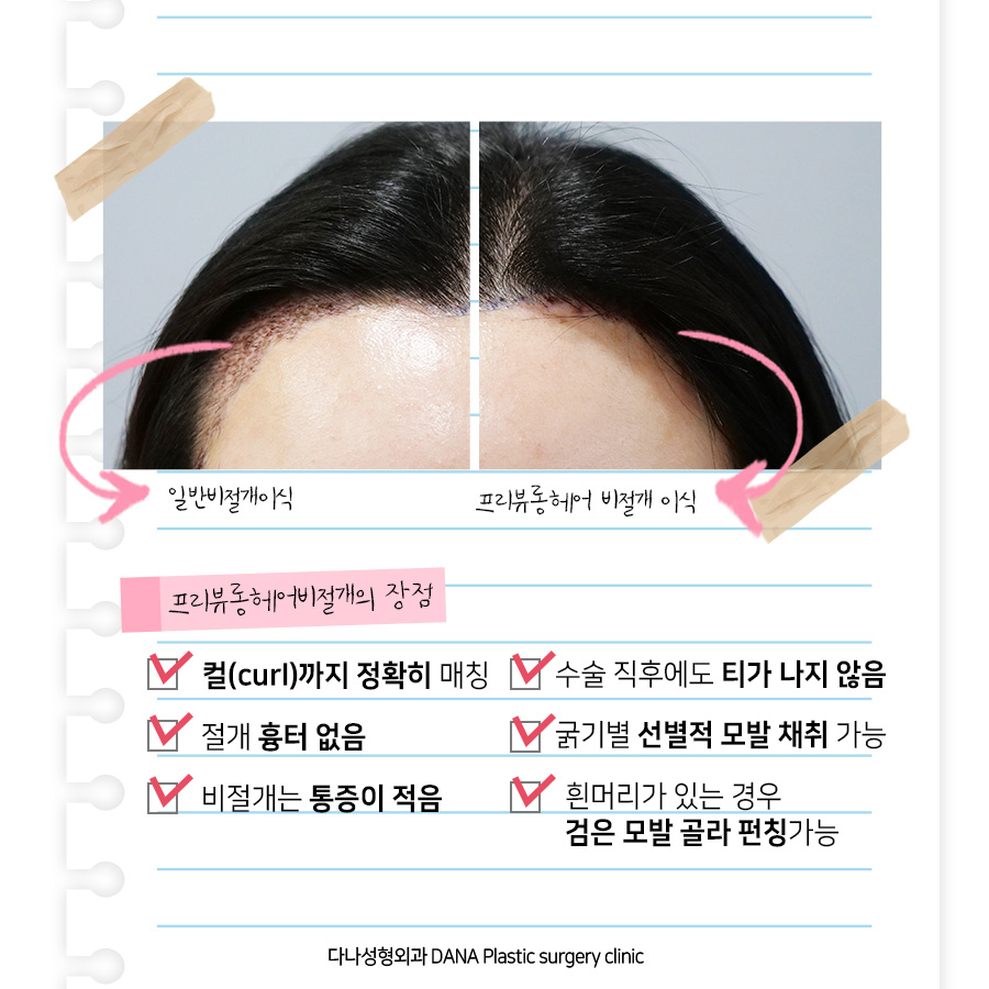 Preview Long Hair No-Shave Hair Transplant: No Visible Signs After Surgery and Back to Work the Next Day? image 5