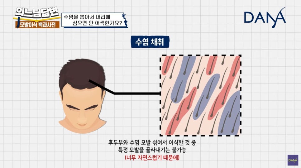 수염이식 머리카락으로 심어도 될까? 관련 이미지 4