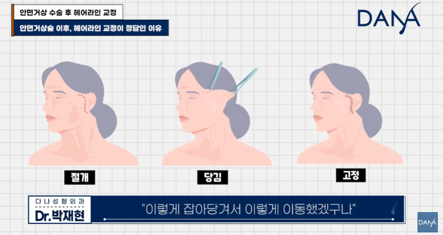 안면거상술 후 흉터와 헤어라인 변형, 자연스럽게 해결하는 방법 관련 이미지 15