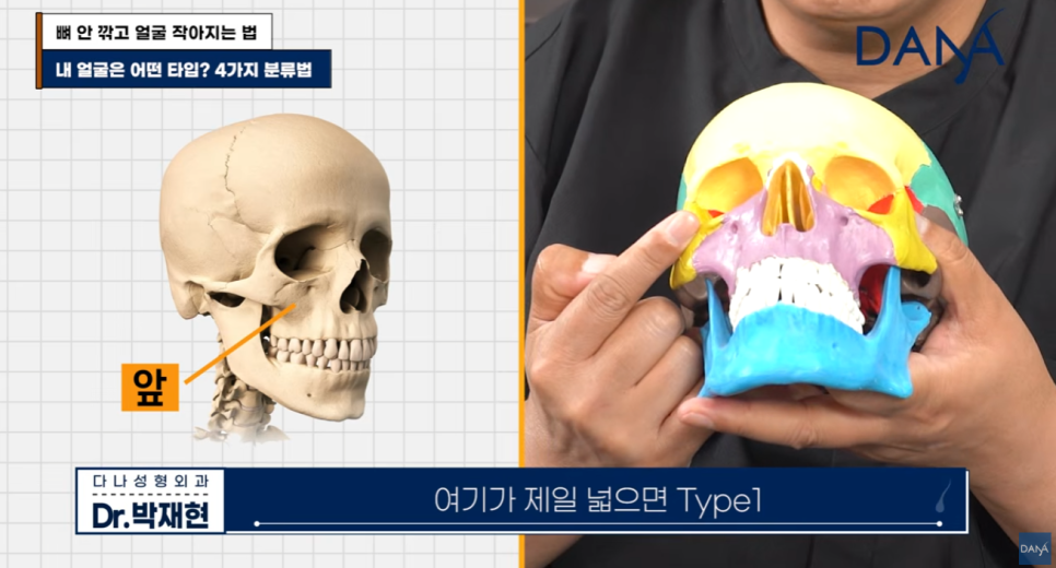 뼈 안 깎고 얼굴 작아지는 법? 광대 수술 효과 없는 관련 이미지 4