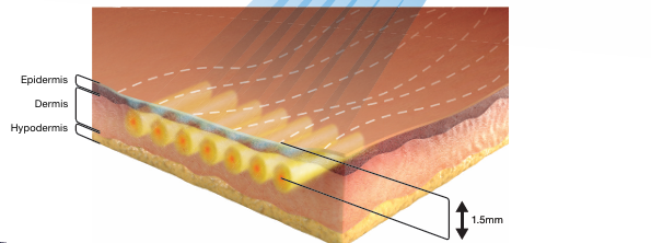 At What Stage Is Shinsa Sofwave Considered? image 3