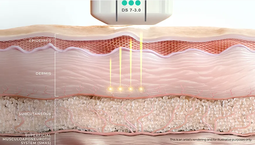 One Month Since Introducing Ulthera Prime: What I Learned from Performing the Procedure Myself image 3