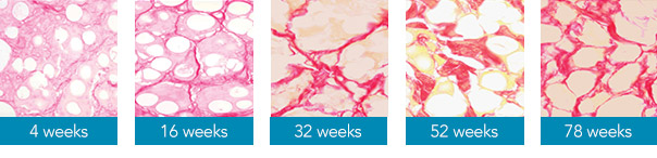 Collagen Volume Booster Radiesse (Part 3) / Gangnam Sinsa Station Dermatology image 3