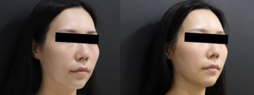 디클래시 용량 및 회차별 효과, 시술 전 알아둘 기준 관련 이미지 10