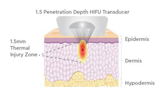소프웨이브&middot;울쎄라를 함께 하는 이유｜ 신사 소프쎄라가 필요한 얼굴 관련 이미지 11