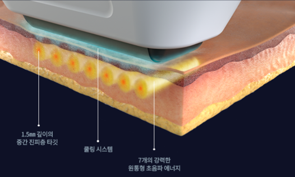 At What Stage Is Shinsa Sofwave Considered? image 2