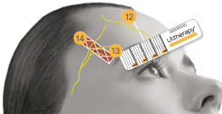 Ultherapy Prime: Facial Sagging Appears Differently Depending on the Area image 7