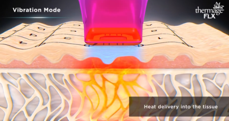 Thermage: A Scientific Method for Restoring Skin Elasticity with Radio Frequency image 3