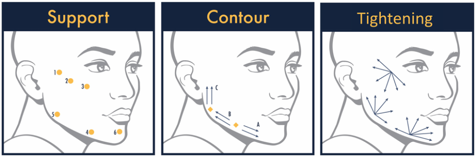 Radiesse... Filler or Booster? image 5