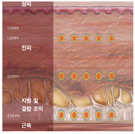The Number of Ultherapy Shots That’s Right for Me, Explained by an Ultherapy Key Doctor image 2