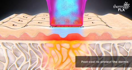 Thermage: A Scientific Method for Restoring Skin Elasticity with Radio Frequency image 5