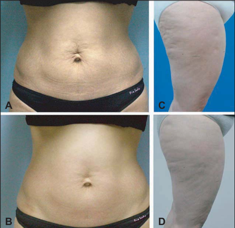 Lifton Dermatology Introduces TriLift ㅣ From Facial Muscles to Body Firmness image 9