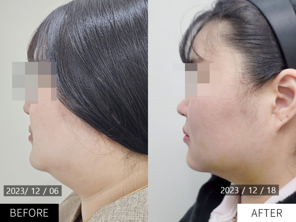 이중턱, 얼굴 지방흡입 부작용 알고 받으세요(부작용, 효과, 후기) / 강남 신사동 피부과 관련 이미지 1