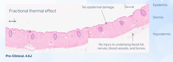 At What Stage Is Shinsa Sofwave Considered? image 12