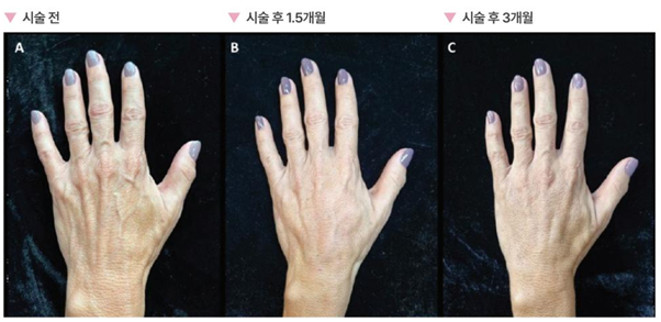 목주름 시술&middot;손등 시술, 디클래시도 가능할까? 관련 이미지 6