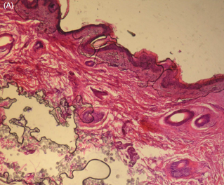 Juvéderm? Ultherapy? Introducing Radiesse, a New Collagen Booster, Part 1 / Gangnam Sinsa Station Dermatology Clinic image 6