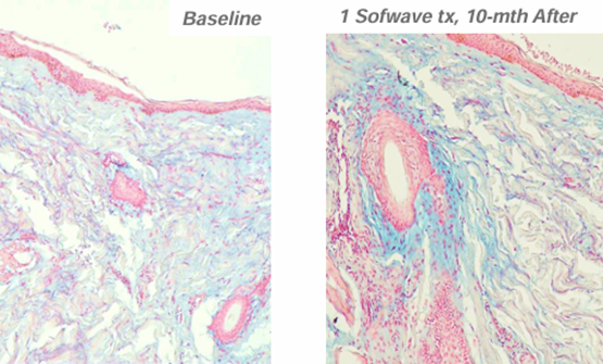 Sinsa SOFWAVE | Official Introduction at Lifton Dermatology Clinic image 7