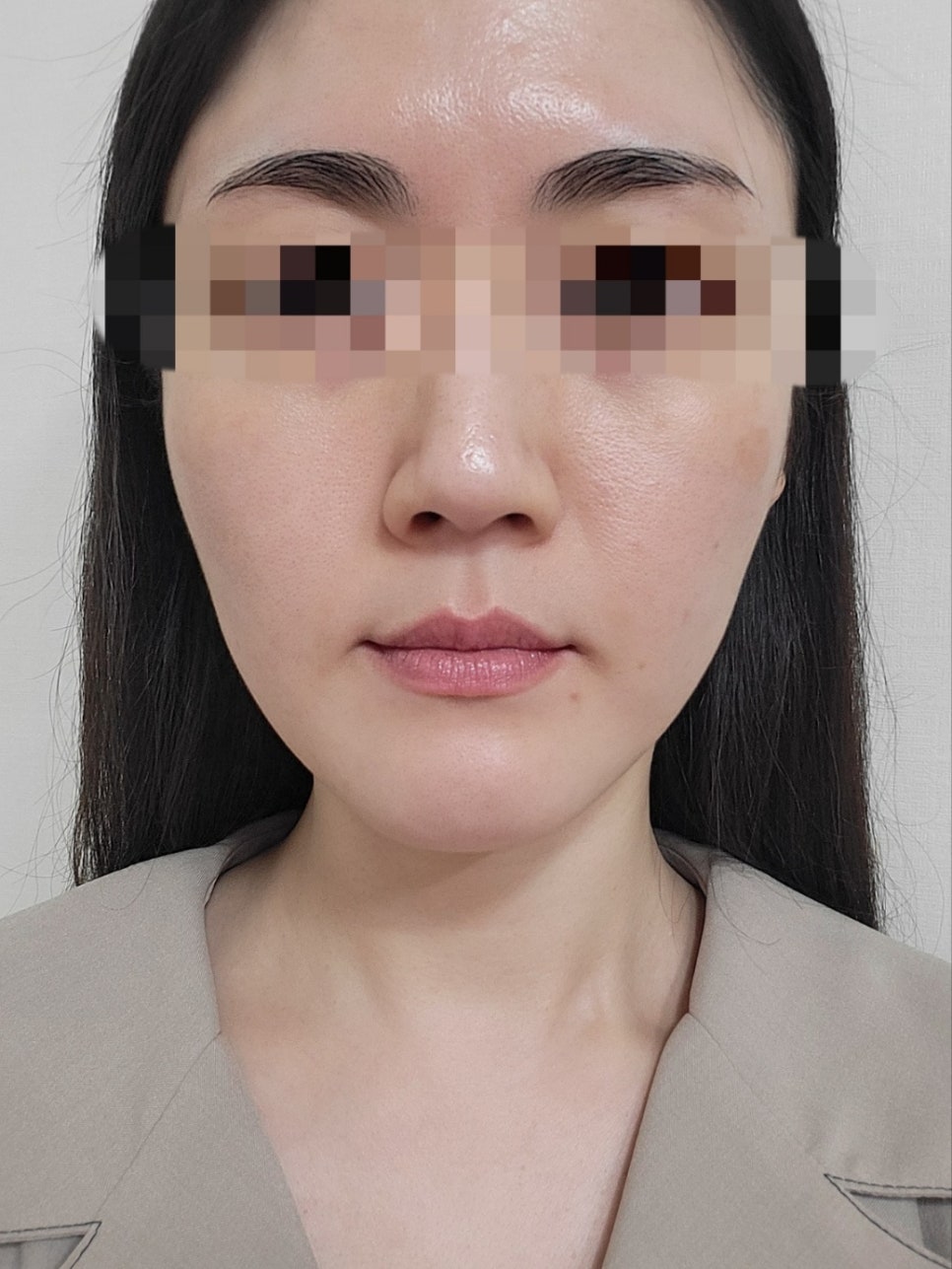리쥬란과 물광주사를 하나로 합친 스킨부스터가 있다?(리쥬란 실제효과,르네힐러)/ 강남 신사동 피부과 관련 이미지 10