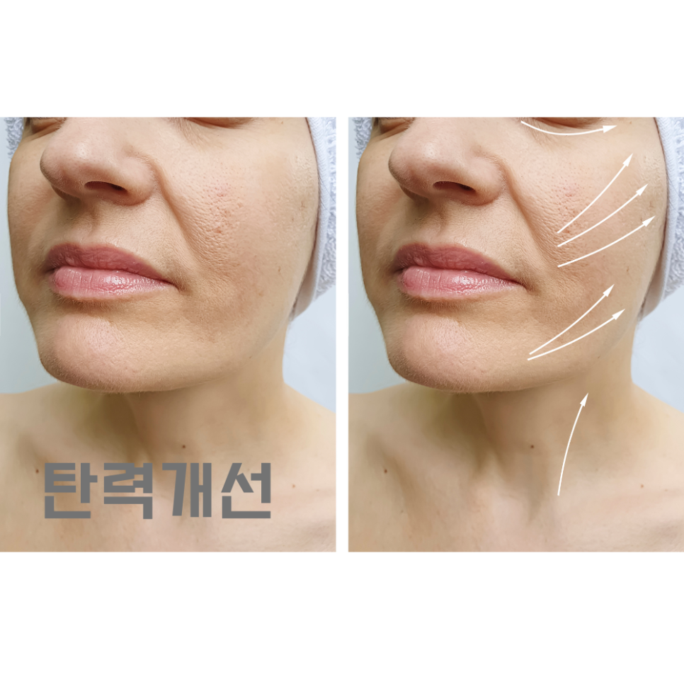 울쎄라 써마지 차이 전격 비교해 드립니다 관련 이미지 4
