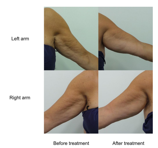 What Treatments Go Well with Ultherapy...? / Radiesse Collagen Booster image 6