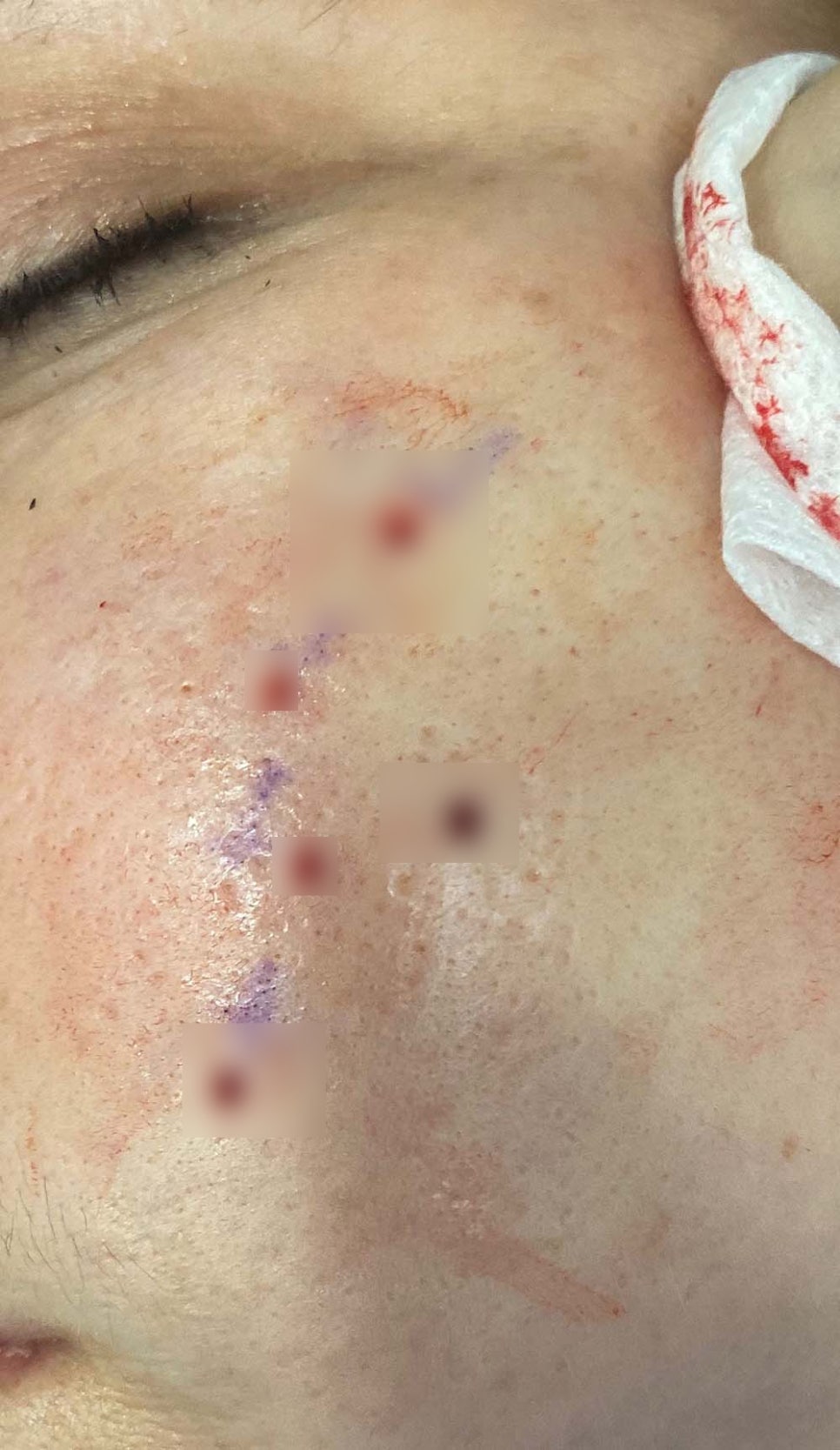 여드름 흉터에 가장 효과적인 치료는 뭘까요 관련 이미지 4