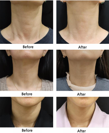 What Is Diclasy? Effects and Treatment Areas of the CaHA Collagen Booster image 11