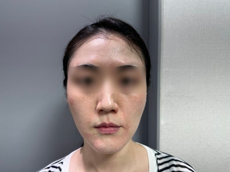 리쥬란과 물광주사를 하나로 합친 스킨부스터가 있다?(리쥬란 실제효과,르네힐러)/ 강남 신사동 피부과 관련 이미지 7