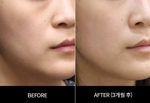 디클래시 용량 및 회차별 효과, 시술 전 알아둘 기준 관련 이미지 2