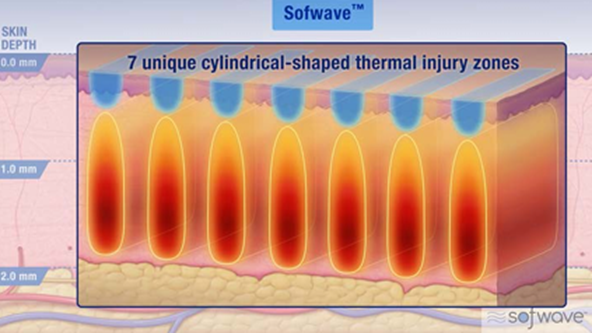 At What Stage Is Shinsa Sofwave Considered? image 11