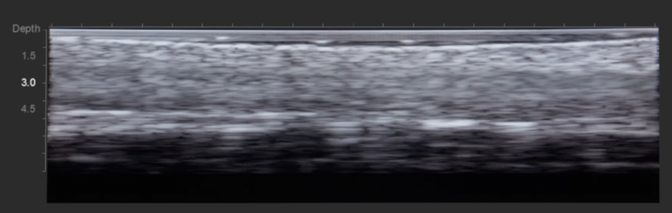 For Ultherapy Prime, precision targeting matters more than the number of shots. image 5