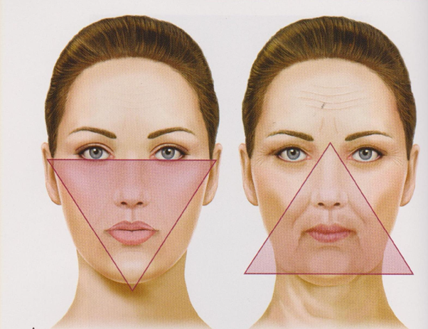 What Is MD Codes Filler? Why It Looks Naturally More Youthful image 3