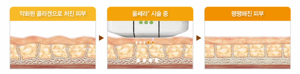 A Complete Guide to Ultherapy Prime Results: Key Points Analyzed Directly by a Dermatology Specialist image 2