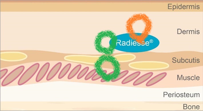 Can Ultherapy and Radiesse Be Performed at the Same Time? / Skin Clinic near Sinsa Station, Gangnam image 1