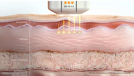 Refton Dermatology Ulthera Prime Seminar | Latest Protocols and Clinical Applications for Lifting image 5