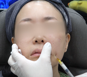 디클래시 용량 및 회차별 효과, 시술 전 알아둘 기준 관련 이미지 6