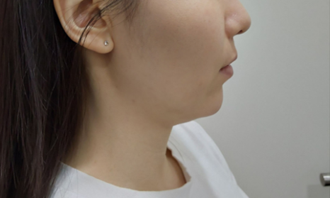 What Is MD Codes Filler? Why It Looks Naturally More Youthful image 6