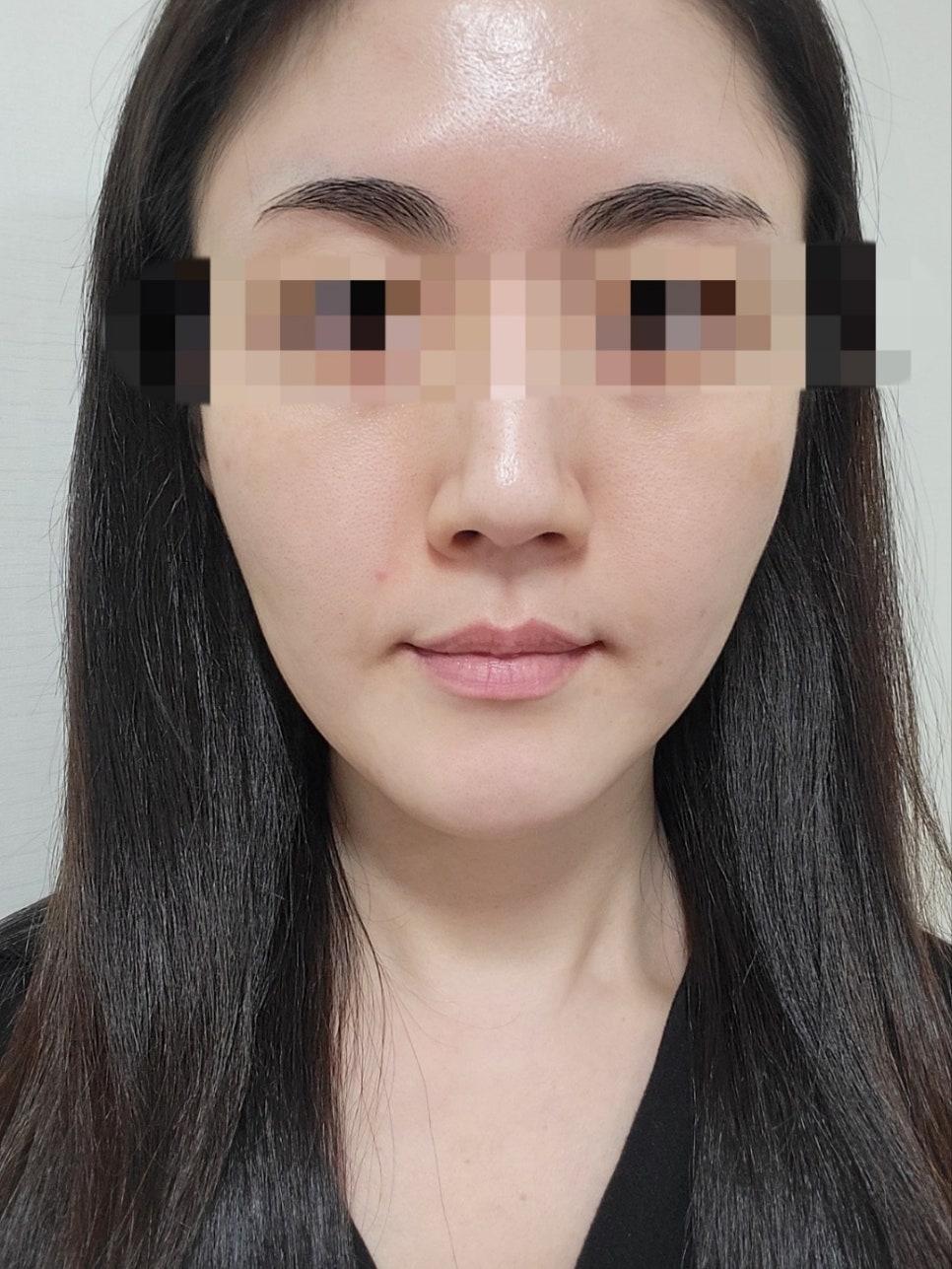 리쥬란과 물광주사를 하나로 합친 스킨부스터가 있다?(리쥬란 실제효과,르네힐러)/ 강남 신사동 피부과 관련 이미지 12