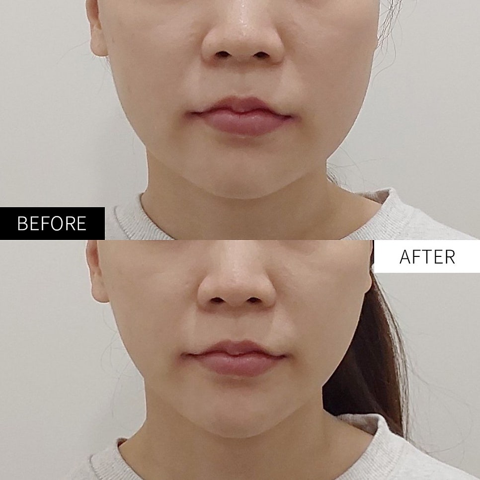 인모드의 업그레이드 버전...온다리프팅?? _ 2편/강남 신사역 피부과 관련 이미지 2