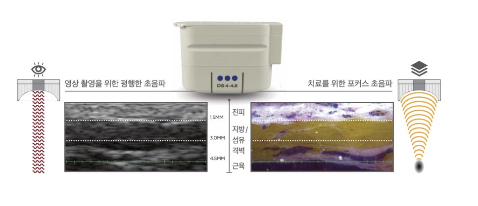 A Complete Guide to Ultherapy Prime Results: Key Points Analyzed Directly by a Dermatology Specialist image 3