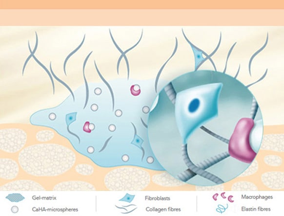 Collagen Volume Booster Radiesse (Part 3) / Gangnam Sinsa Station Dermatology image 5