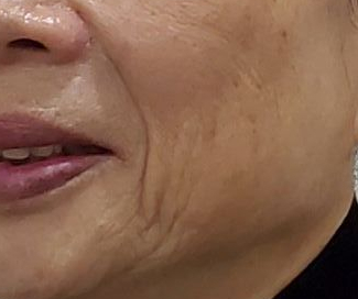 레디어스 효과..."자연스런" 볼륨과 탄력 개선에 탁월한 신개념 스킨부스터 관련 이미지 3