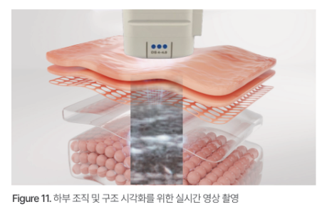 피부과 전문의가 알려주는 울쎄라피프라임 vs 울쎄라 어떤 점이 달라졌을까? 관련 이미지 5