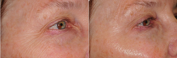 If You Didn’t See Results After Thermage, Be Sure to Read This (Must-Read for Those Who Feel Thermage Doesn’t Work) / Gangnam Sinsa Station Dermatology Clinic image 6