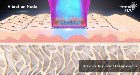 Thermage: A Scientific Method for Restoring Skin Elasticity with Radio Frequency image 2